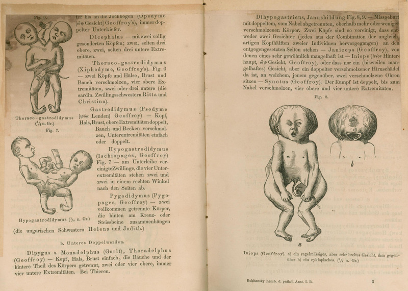 Ilustracja czarno-biała przedstawiająca cztery rysunki bliźniąt syjamskich zrośniętych tułowiami, miednicami i głowami.