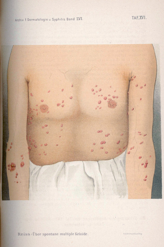 Obraz przedstawia kolorową ilustrację z publikacji prof. W. Reissa „Ueber spontane multiple Keloide” opublikowanej w periodyku Archiv für Dermatologie und Syphilis Bd. LVI 1901.
Na ilustracji widać przednią część tułowia i części ramion oraz brzucha dorosłej osoby, pokrytych licznymi wyniosłymi, czerwonawymi guzowatymi zmianami skórnymi o różnym rozmiarze – typowymi dla keloidów. Zmiany rozmieszczone są symetrycznie po obu stronach torsu i na ramionach, niektóre większe i bardziej wyraźne. Chory ma na biodrach fałdy materiału – wygląda to jak luźno zawiązana tkanina lub bielizna.
W górnej części strony widnieje nagłówek: Archiv f. Dermatologie u. Syphilis Band LVI. TAF. XVI.
Pod ilustracją znajduje się podpis „Reiss: Über spontane multiple Keloide.”