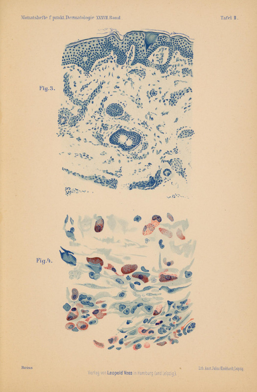 Obraz przedstawia dwa szczegółowe rysunki mikroskopowe (Fig. 3 i Fig. 4) z pracy W. Reissa „Über Urticaria pigmentosa perstans” (Hamburg 1903)
Rysunek oznaczony jako Fig. 3 przedstawia
fragment skóry wraz z włosem wyrastającym z mieszka włosowego (tzw. cebulką).
Na samej górze widoczna jest cienka warstwa naskórka w postaci zwartego, ciemnego układu komórek, ułożonych warstwowo.
Pod naskórkiem znajdują się struktury skóry właściwej. W środku i nieco poniżej przebija się owalna struktura mieszek włosowy.
Całość jest narysowana odcieniami niebieskiego, struktury tła i przestrzenie międzykomórkowe są jasnoniebieskie, a komórki i jądra silniej nasycone barwą.
Rysunek oznaczony jako Fig. 4 przedstawia komórki tuczne (mastocyty) uwidocznione dzięki metodzie immersji i barwieniu błękitem metylenowym.
Komórki rozmieszczone są nieregularnie, w grupach lub luźnych skupiskach, na tle drobnego, jasnego tła.
Każda komórka ma charakterystyczny owalny lub spłaszczony kształt z gęstym, ziarnistym wypełnieniem – w wielu z nich widać wyraźne, grudkowate ziarna, zaznaczone ciemniejszym niebieskim lub czerwonawym tonem. Niektóre komórki mają wyraźne jądro. Część ma kształt serca lub łezki.
Barwienie sprawia, że ziarnistości dają czerwony punktowy akcent na tle jasnoniebieskiej cytoplazmy.
Komórki są różnej wielkości – od drobnych po większe z dużą ilością ziaren.