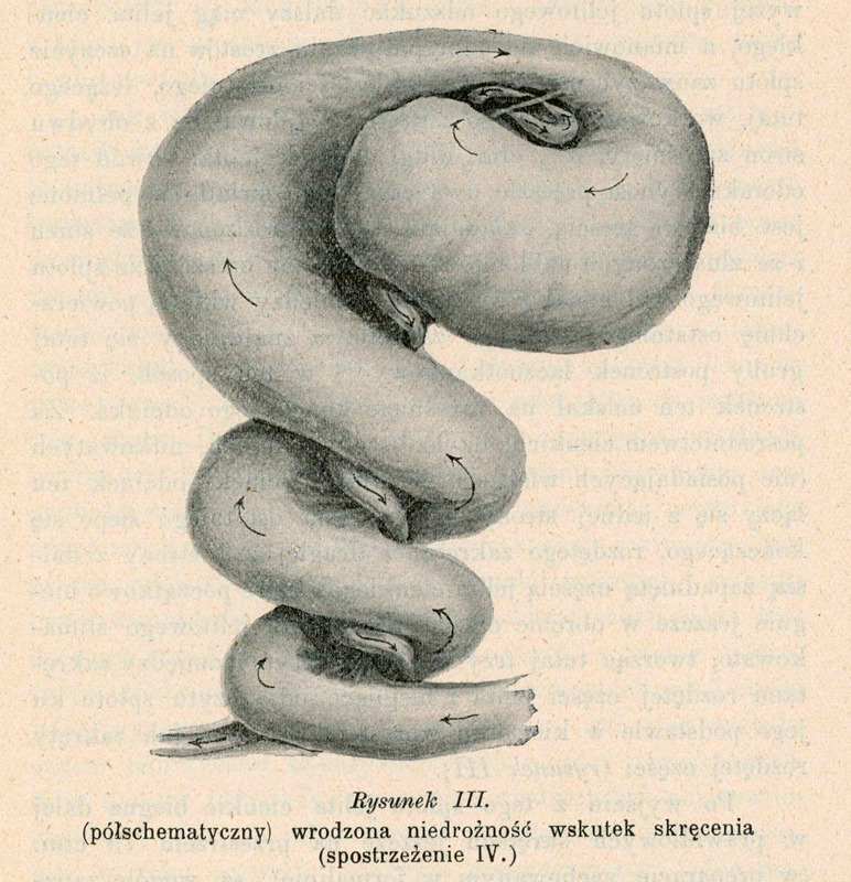 Ilustracja półschematyczna oznaczona jako „Rysunek III” przedstawia przypadek wrodzonej niedrożności jelit spowodowanej skręceniem. Obraz pochodzi z obserwacji klinicznej oznaczonej jako „Spostrzeżenie IV”. Schemat ukazuje skręcony wokół krezki fragment jelita cienkiego, który prowadzi do mechanicznej niedrożności przewodu pokarmowego. Strzałki wskazują kierunek skrętu. Jelito idąc od dołu ku górze jest coraz bardziej rozdęte. Pod rysunkiem znajduje się podpis: „Rysunek III. (półschematyczny) wrodzona niedrożność wskutek skręcenia (spostrzeżenie IV.)” Poniżej znajduje się dalszy opis przypadku klinicznego oraz podpisy autorów: Dr S. Ciechanowski i Dr L. K. Gliński.
Papier ma pożółkły odcień, wskazujący na wiek dokumentu.
