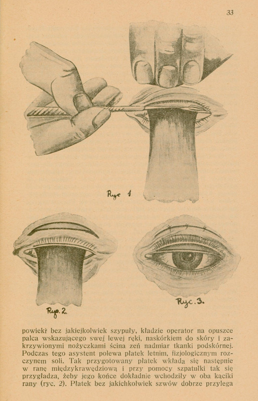 Skan ilustracji składa się z trzech ręcznie wykonanych ołówkiem rysunków.
Pierwszy rysunek ukazuje dłoń trzymającą górną powiekę z podłożoną płytką Jaegera odwracającą brzeg powieki. Jednocześnie druga dłoń przy pomocy nożyka Graefego prowadzi cięcie środkiem między tylną a przednią krawędzią brzegu spojówki tak, żeby powiekę rozdzielić na dwie warstwy.
Drugi rysunek ukazuje tę sama powiekę z podłożoną płytką Jaegera i zaznaczeniam paska skóry o szerokości ok. 3 mm, który będzie wycięty.
Trzeci rysunek pokazuje efekt końcowy: powieka została zszyta. Delikatne znaczniki sugerują miejsca, w których umieszczono szwy. Powieka wygląda naturalnie. Oko jest otwarte z widoczną tęczówką oka. Rysunek sugeruje, że oko funkcjonuje prawidłowo bez mechanicznego napięcia lub nierówności.