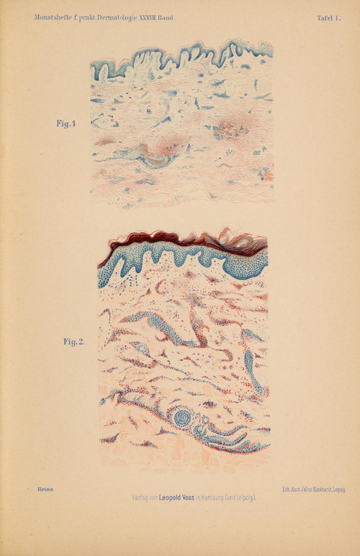 Poniżej znajduje się rozszerzony opis ilustracji z publikacji Władysława Reissa „Über Urticaria pigmentosa perstans” (Hamburg, 1903).
Plansza zawiera dwa rysunki opisane jako „Fig. 1” (u góry) i „Fig. 2” (niżej) – umieszczone na jasnym papierze.
Nad rysunkami widoczne są nagłówki: Monatshefte f. prakt. Dermatologie XXXVII. Band oraz Tafel I.
Na dole strony drobnym drukiem: nazwisko Reiss, wydawnictwo Verlag von Leopold Voss in Hamburg (und Leipzig), oraz litografia: Lith. Anst. Julius Klinkhardt, Leipzig.
Rysunek górny przedstawia schemat mikroskopowy górnej warstwy skóry – cienka warstwa naskórka i powierzchniowa skóra właściwa. Naskórek koloru niebieskiego, oddzielony od warstwy podskórnej bardzo delikatnymi pasmami włóknistymi lub płynowymi. Warstwy skóry właściwej przedstawione jako niemal jednolita, delikatna tekstura o drobnych punkcikach i falach koloru różowego.
Rysunek dolny znacznie większy przedstawia bardziej zaawansowaną formę chorobową.
U góry gęstsza warstwa kolczystego i ziarnistego naskórka w kolorze granatowo-niebieskim, z widocznym ciemniejszym paskiem rogowej warstwy (mniej regularnie falującej).
Poniżej obszar skóry właściwej w odcieniach łososiowo-czerwonych z intensywnymi plamkami i mniejszymi skupiskami punktów – to prawdopodobnie mastocyty (komórki tuczne) rozproszone wśród tkanki.
Dodatkowo w dolnej części widoczne spiralne lub kuliste formy – mogą to być przekroje struktur gruczołów lub skupisk komórkowych.
Cały rysunek wykonany z dużą precyzją i artystyczną dbałością o różnorodność strukturalną.