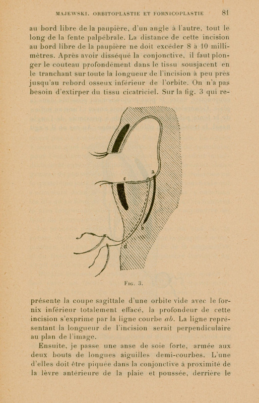 Skan ilustracji przedstawia schematyczny, anatomiczny przekrój przez oczodół człowieka — w widoku z boku. Obraz ma na celu pokazanie techniki chirurgicznej stosowanej w zabiegu orbitoplastyki i fornikoplastyki, czyli rekonstrukcji oczodołu i fałdu spojówkowego. Centralną część rysunku stanowi pusta przestrzeń oczodołu (miejsce, gdzie normalnie znajdowałaby się gałka oczna), otoczona przez struktury tkanek miękkich. Skan ilustracji przedstawia schematyczny, anatomiczny przekrój przez oczodół człowieka — w widoku z boku. Obraz ma na celu pokazanie techniki chirurgicznej stosowanej w zabiegu orbitoplastyki i fornikoplastyki, czyli rekonstrukcji oczodołu i fałdu spojówkowego.
________________________________________
Centralną część rysunku stanowi pusta przestrzeń oczodołu (miejsce, gdzie normalnie znajdowałaby się gałka oczna), otoczona przez struktury tkanek miękkich.
Górna i dolna powieka są przedstawione jako zakrzywione linie z małymi zaznaczeniami rzęs, co wskazuje ich zewnętrzne brzegi.
Wewnątrz rysunku przebiegają trzy oznaczone punkty i linie:
Punkt a i punkt b są połączone zakrzywioną linią, która reprezentuje głębokość nacięcia w obrębie spojówki i tkanek oczodołu.
Punkt c i punkt d pokazują przebieg nici chirurgicznej, która została wprowadzona w ramach zabiegu — linia od c do d biegnie przez dolną część oczodołu.
Całość ukazuje sytuację po usunięciu gałki ocznej, gdzie dąży się do odbudowy przestrzeni oczodołowej pod przyszłą protezę oka.