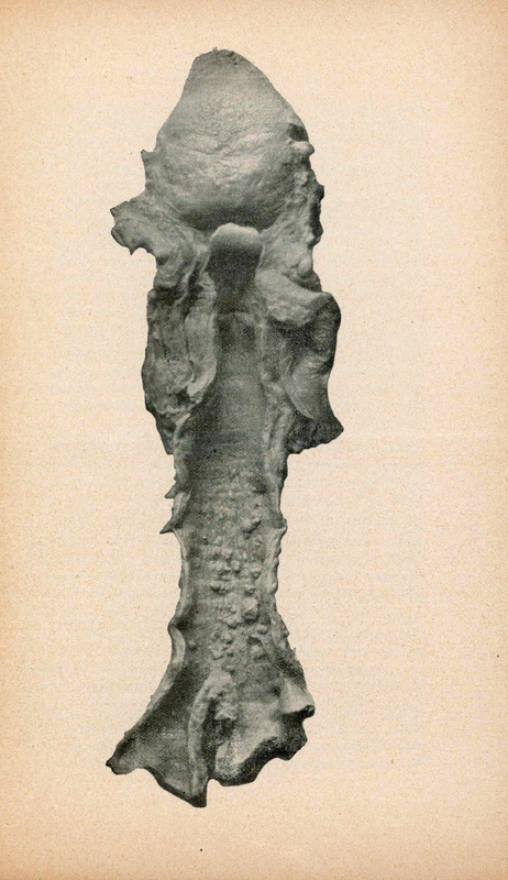 Zdjęcie preparatu, otwartej tchawicy z mnogimi zmianami nowotworowymi w postaci różnej wielkości uwypukleń błony śluzowej.