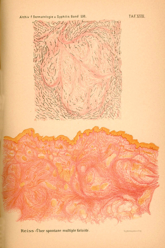 Obraz przedstawia kolorową ilustrację z publikacji prof. W. Reissa „Ueber spontane multiple Keloide” opublikowanej w periodyku Archiv für Dermatologie und Syphilis Bd. LVI 1901.
Górny nagłówek strony zawiera napis: Archiv f. Dermatologie u. Syphilis Band LVI. TAF XVIII.
Poniżej ilustracja składająca się z dwóch części:
Górny rysunek przedstawia obraz mikroskopowy: falujące, cienkie linie (zarysy włókien lub struktur kolagenowych) w odcieniach czerni i szarości z elementami lekko czerwonymi.
Dolna część to barwna ilustracja histologiczna: rozmyte, rozległe struktury kolagenowe w odcieniach różowo-pomarańczowych, z jasnożółtymi obszarami – obraz rodzący skojarzenia z przekrojem tkanki bliznowatej lub keloidem.
Pod ilustracjami znajduje się podpis: „Reiss: Über spontane multiple Keloide.”