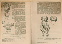 Ilustracja czarno-biała przedstawiająca cztery  rysunki bliźniąt syjamskich zrośniętych tułowiami, miednicami i głowami.  