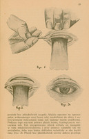 Skan ilustracji składa się z trzech ręcznie wykonanych ołówkiem rysunków.
Pierwszy rysunek ukazuje dłoń trzymającą górną powiekę z podłożoną płytką Jaegera odwracającą brzeg powieki. Jednocześnie druga dłoń przy pomocy nożyka Graefego prowadzi cięcie środkiem między tylną a przednią krawędzią brzegu spojówki tak, żeby powiekę rozdzielić na dwie warstwy.
Drugi rysunek ukazuje tę sama powiekę z podłożoną płytką Jaegera i zaznaczeniam paska skóry o szerokości ok. 3 mm, który będzie wycięty.
Trzeci rysunek pokazuje efekt końcowy: powieka została zszyta. Delikatne znaczniki sugerują miejsca, w których umieszczono szwy. Powieka wygląda naturalnie. Oko jest otwarte z widoczną tęczówką oka. Rysunek sugeruje, że oko funkcjonuje prawidłowo bez mechanicznego napięcia lub nierówności.