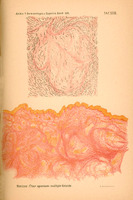 Obraz przedstawia kolorową ilustrację z publikacji prof. W. Reissa „Ueber spontane multiple Keloide” opublikowanej w periodyku Archiv für Dermatologie und Syphilis Bd. LVI 1901.
Górny nagłówek strony zawiera napis: Archiv f. Dermatologie u. Syphilis Band LVI. TAF XVIII.
Poniżej ilustracja składająca się z dwóch części:
Górny rysunek przedstawia obraz mikroskopowy: falujące, cienkie linie (zarysy włókien lub struktur kolagenowych) w odcieniach czerni i szarości z elementami lekko czerwonymi.
Dolna część to barwna ilustracja histologiczna: rozmyte, rozległe struktury kolagenowe w odcieniach różowo-pomarańczowych, z jasnożółtymi obszarami – obraz rodzący skojarzenia z przekrojem tkanki bliznowatej lub keloidem.
Pod ilustracjami znajduje się podpis: „Reiss: Über spontane multiple Keloide.”