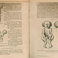 Ilustracja czarno-biała przedstawiająca cztery rysunki bliźniąt syjamskich zrośniętych tułowiami, miednicami i głowami.