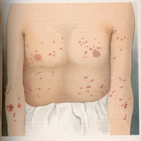 Obraz przedstawia kolorową ilustrację z publikacji prof. W. Reissa „Ueber spontane multiple Keloide” opublikowanej w periodyku Archiv für Dermatologie und Syphilis Bd. LVI 1901.
Na ilustracji widać przednią część tułowia i części ramion oraz brzucha dorosłej osoby, pokrytych licznymi wyniosłymi, czerwonawymi guzowatymi zmianami skórnymi o różnym rozmiarze – typowymi dla keloidów. Zmiany rozmieszczone są symetrycznie po obu stronach torsu i na ramionach, niektóre większe i bardziej wyraźne. Chory ma na biodrach fałdy materiału – wygląda to jak luźno zawiązana tkanina lub bielizna.
W górnej części strony widnieje nagłówek: Archiv f. Dermatologie u. Syphilis Band LVI. TAF. XVI.
Pod ilustracją znajduje się podpis „Reiss: Über spontane multiple Keloide.”