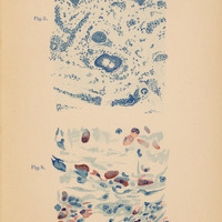 Obraz przedstawia dwa szczegółowe rysunki mikroskopowe (Fig. 3 i Fig. 4) z pracy W. Reissa „Über Urticaria pigmentosa perstans” (Hamburg 1903)
Rysunek oznaczony jako Fig. 3 przedstawia
fragment skóry wraz z włosem wyrastającym z mieszka włosowego (tzw. cebulką).
Na samej górze widoczna jest cienka warstwa naskórka w postaci zwartego, ciemnego układu komórek, ułożonych warstwowo.
Pod naskórkiem znajdują się struktury skóry właściwej. W środku i nieco poniżej przebija się owalna struktura mieszek włosowy.
Całość jest narysowana odcieniami niebieskiego, struktury tła i przestrzenie międzykomórkowe są jasnoniebieskie, a komórki i jądra silniej nasycone barwą.
Rysunek oznaczony jako Fig. 4 przedstawia komórki tuczne (mastocyty) uwidocznione dzięki metodzie immersji i barwieniu błękitem metylenowym.
Komórki rozmieszczone są nieregularnie, w grupach lub luźnych skupiskach, na tle drobnego, jasnego tła.
Każda komórka ma charakterystyczny owalny lub spłaszczony kształt z gęstym, ziarnistym wypełnieniem – w wielu z nich widać wyraźne, grudkowate ziarna, zaznaczone ciemniejszym niebieskim lub czerwonawym tonem. Niektóre komórki mają wyraźne jądro. Część ma kształt serca lub łezki.
Barwienie sprawia, że ziarnistości dają czerwony punktowy akcent na tle jasnoniebieskiej cytoplazmy.
Komórki są różnej wielkości – od drobnych po większe z dużą ilością ziaren.