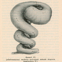 Ilustracja półschematyczna oznaczona jako „Rysunek III” przedstawia przypadek wrodzonej niedrożności jelit spowodowanej skręceniem. Obraz pochodzi z obserwacji klinicznej oznaczonej jako „Spostrzeżenie IV”. Schemat ukazuje skręcony wokół krezki fragment jelita cienkiego, który prowadzi do mechanicznej niedrożności przewodu pokarmowego. Strzałki wskazują kierunek skrętu. Jelito idąc od dołu ku górze jest coraz bardziej rozdęte. Pod rysunkiem znajduje się podpis: „Rysunek III. (półschematyczny) wrodzona niedrożność wskutek skręcenia (spostrzeżenie IV.)” Poniżej znajduje się dalszy opis przypadku klinicznego oraz podpisy autorów: Dr S. Ciechanowski i Dr L. K. Gliński.
Papier ma pożółkły odcień, wskazujący na wiek dokumentu.