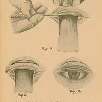 Skan ilustracji składa się z trzech ręcznie wykonanych ołówkiem rysunków.
Pierwszy rysunek ukazuje dłoń trzymającą górną powiekę z podłożoną płytką Jaegera odwracającą brzeg powieki. Jednocześnie druga dłoń przy pomocy nożyka Graefego prowadzi cięcie środkiem między tylną a przednią krawędzią brzegu spojówki tak, żeby powiekę rozdzielić na dwie warstwy.
Drugi rysunek ukazuje tę sama powiekę z podłożoną płytką Jaegera i zaznaczeniam paska skóry o szerokości ok. 3 mm, który będzie wycięty.
Trzeci rysunek pokazuje efekt końcowy: powieka została zszyta. Delikatne znaczniki sugerują miejsca, w których umieszczono szwy. Powieka wygląda naturalnie. Oko jest otwarte z widoczną tęczówką oka. Rysunek sugeruje, że oko funkcjonuje prawidłowo bez mechanicznego napięcia lub nierówności.