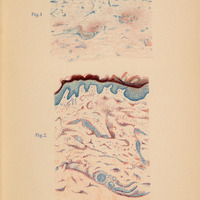 Poniżej znajduje się rozszerzony opis ilustracji z publikacji Władysława Reissa „Über Urticaria pigmentosa perstans” (Hamburg, 1903).
Plansza zawiera dwa rysunki opisane jako „Fig. 1” (u góry) i „Fig. 2” (niżej) – umieszczone na jasnym papierze.
Nad rysunkami widoczne są nagłówki: Monatshefte f. prakt. Dermatologie XXXVII. Band oraz Tafel I.
Na dole strony drobnym drukiem: nazwisko Reiss, wydawnictwo Verlag von Leopold Voss in Hamburg (und Leipzig), oraz litografia: Lith. Anst. Julius Klinkhardt, Leipzig.
Rysunek górny przedstawia schemat mikroskopowy górnej warstwy skóry – cienka warstwa naskórka i powierzchniowa skóra właściwa. Naskórek koloru niebieskiego, oddzielony od warstwy podskórnej bardzo delikatnymi pasmami włóknistymi lub płynowymi. Warstwy skóry właściwej przedstawione jako niemal jednolita, delikatna tekstura o drobnych punkcikach i falach koloru różowego.
Rysunek dolny znacznie większy przedstawia bardziej zaawansowaną formę chorobową.
U góry gęstsza warstwa kolczystego i ziarnistego naskórka w kolorze granatowo-niebieskim, z widocznym ciemniejszym paskiem rogowej warstwy (mniej regularnie falującej).
Poniżej obszar skóry właściwej w odcieniach łososiowo-czerwonych z intensywnymi plamkami i mniejszymi skupiskami punktów – to prawdopodobnie mastocyty (komórki tuczne) rozproszone wśród tkanki.
Dodatkowo w dolnej części widoczne spiralne lub kuliste formy – mogą to być przekroje struktur gruczołów lub skupisk komórkowych.
Cały rysunek wykonany z dużą precyzją i artystyczną dbałością o różnorodność strukturalną.