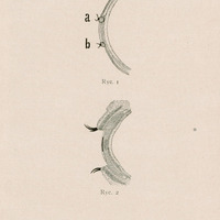 Skan przedstawia dwie ilustracje anatomiczne wykonane w stylu technicznego rysunku medycznego. Obie przedstawiają przekrój poprzeczny przez fragment ludzkiej gałki ocznej — w kontekście przygotowania podłoża dla epiprotezy, czyli zewnętrznej protezy oka.
Na rysunku pierwszym widoczne są dwa szwy, mocujące płaty spojówkowe tak, by rogówka została na znacznej przestrzeni pokryta podwójną warstwą spojówki. Całość wygląda jak etap przygotowania tkanek do dalszych czynności chirurgicznych. Drugi rysunek pokazuje ten sam przekrój, ale z większą ilością szczegółów. Zaznaczona jest wewnętrzna część powieki z obecnością epiprotezy. Linie i cieniowanie wskazują na przestrzenne ukształtowanie tkanek i ich warstwową budowę.