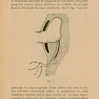 Skan ilustracji przedstawia schematyczny, anatomiczny przekrój przez oczodół człowieka — w widoku z boku. Obraz ma na celu pokazanie techniki chirurgicznej stosowanej w zabiegu orbitoplastyki i fornikoplastyki, czyli rekonstrukcji oczodołu i fałdu spojówkowego. Centralną część rysunku stanowi pusta przestrzeń oczodołu (miejsce, gdzie normalnie znajdowałaby się gałka oczna), otoczona przez struktury tkanek miękkich. Skan ilustracji przedstawia schematyczny, anatomiczny przekrój przez oczodół człowieka — w widoku z boku. Obraz ma na celu pokazanie techniki chirurgicznej stosowanej w zabiegu orbitoplastyki i fornikoplastyki, czyli rekonstrukcji oczodołu i fałdu spojówkowego.
________________________________________
Centralną część rysunku stanowi pusta przestrzeń oczodołu (miejsce, gdzie normalnie znajdowałaby się gałka oczna), otoczona przez struktury tkanek miękkich.
Górna i dolna powieka są przedstawione jako zakrzywione linie z małymi zaznaczeniami rzęs, co wskazuje ich zewnętrzne brzegi.
Wewnątrz rysunku przebiegają trzy oznaczone punkty i linie:
Punkt a i punkt b są połączone zakrzywioną linią, która reprezentuje głębokość nacięcia w obrębie spojówki i tkanek oczodołu.
Punkt c i punkt d pokazują przebieg nici chirurgicznej, która została wprowadzona w ramach zabiegu — linia od c do d biegnie przez dolną część oczodołu.
Całość ukazuje sytuację po usunięciu gałki ocznej, gdzie dąży się do odbudowy przestrzeni oczodołowej pod przyszłą protezę oka.