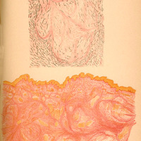 Obraz przedstawia kolorową ilustrację z publikacji prof. W. Reissa „Ueber spontane multiple Keloide” opublikowanej w periodyku Archiv für Dermatologie und Syphilis Bd. LVI 1901.
Górny nagłówek strony zawiera napis: Archiv f. Dermatologie u. Syphilis Band LVI. TAF XVIII.
Poniżej ilustracja składająca się z dwóch części:
Górny rysunek przedstawia obraz mikroskopowy: falujące, cienkie linie (zarysy włókien lub struktur kolagenowych) w odcieniach czerni i szarości z elementami lekko czerwonymi.
Dolna część to barwna ilustracja histologiczna: rozmyte, rozległe struktury kolagenowe w odcieniach różowo-pomarańczowych, z jasnożółtymi obszarami – obraz rodzący skojarzenia z przekrojem tkanki bliznowatej lub keloidem.
Pod ilustracjami znajduje się podpis: „Reiss: Über spontane multiple Keloide.”