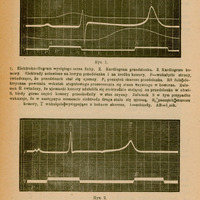 Strona pochodzi z historycznego tekstu medycznego napisanego po polsku. Zawiera dwa wykresy przedstawiające elektrodiagramy serca żaby, oznaczone jako Rys. 1 i Rys. 2.
Rys. 1: Trzy nakładające się krzywe przedstawiające:
1. Elektrokardiogram wyciętego serca żaby,
2. Kardiogram przedsionka,
3. Kardiogram komory.
Wykres opisany jest literami (P, P₁, R, S, T) oznaczającymi różne fazy aktywności elektrycznej serca. Dodatkowo zaznaczono odcinki czasu (AB = 1 sekunda). Tekst pod wykresem tłumaczy znaczenie poszczególnych załamków i ich związek z aktywnością przedsionków i komór serca.
Rys. 2: Kolejny elektrokardiogram serca żaby, z elektrodami umieszczonymi na bulbusie aorty i na koniuszku serca. Opis informuje, że oznaczenia liter są takie same jak w Rys. 1.
Na górze i dole strony znajduje się tekst opisujący eksperyment i interpretację wyników. Pismo ma charakter naukowy i medyczny, używa terminologii z zakresu fizjologii serca i elektrokardiografii.
Papier ma pożółkły odcień, wskazujący na wiek dokumentu.