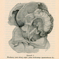 Ilustracja anatomiczna przedstawiająca przypadek wrodzonego braku dolnej części jelita biodrowego. Obraz pochodzi z obserwacji klinicznej oznaczonej jako „Spostrzeżenie II”. Widoczne są szczegóły układu pokarmowego, z wyraźnie zaznaczonym miejscem braku fragmentu jelita cienkiego. Pod ilustracją znajduje się podpis: „Rysunek I. Wrodzony brak dolnej części jelita biodrowego (spostrzeżenie II.)”
Papier ma pożółkły odcień, wskazujący na wiek dokumentu.

